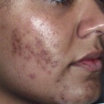 Quitar cicatruces de acne